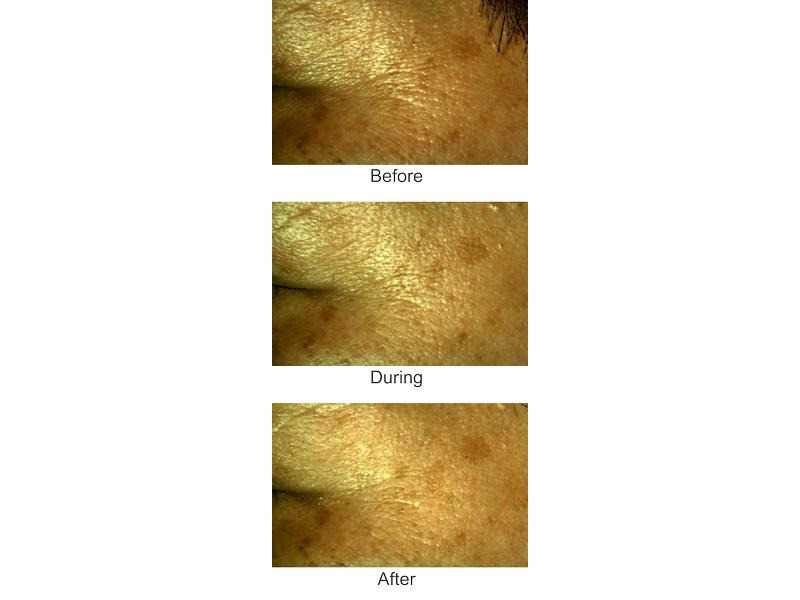 Silk'n Antiaging-Gerät FaceTite Mini