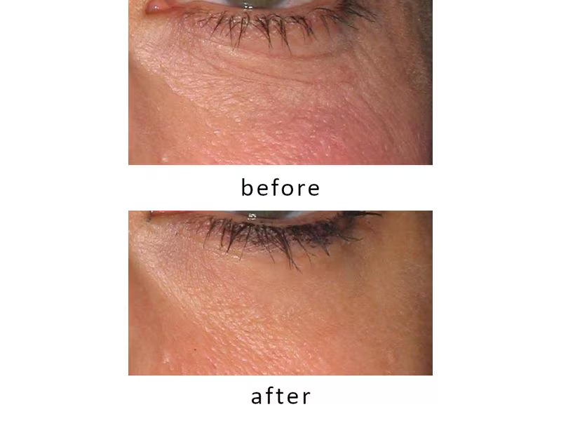 Silk'n Antiaging-Gerät FaceTite Revive Cordless Weiss